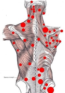 myofascial pain trigger points