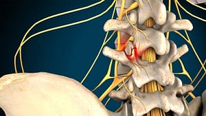 Facet Joint Syndrome