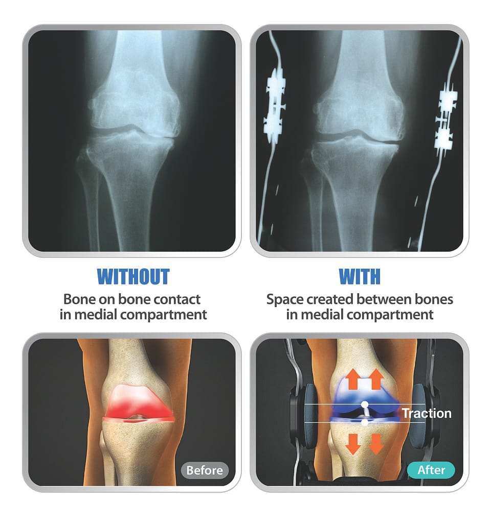 knee brace before and after