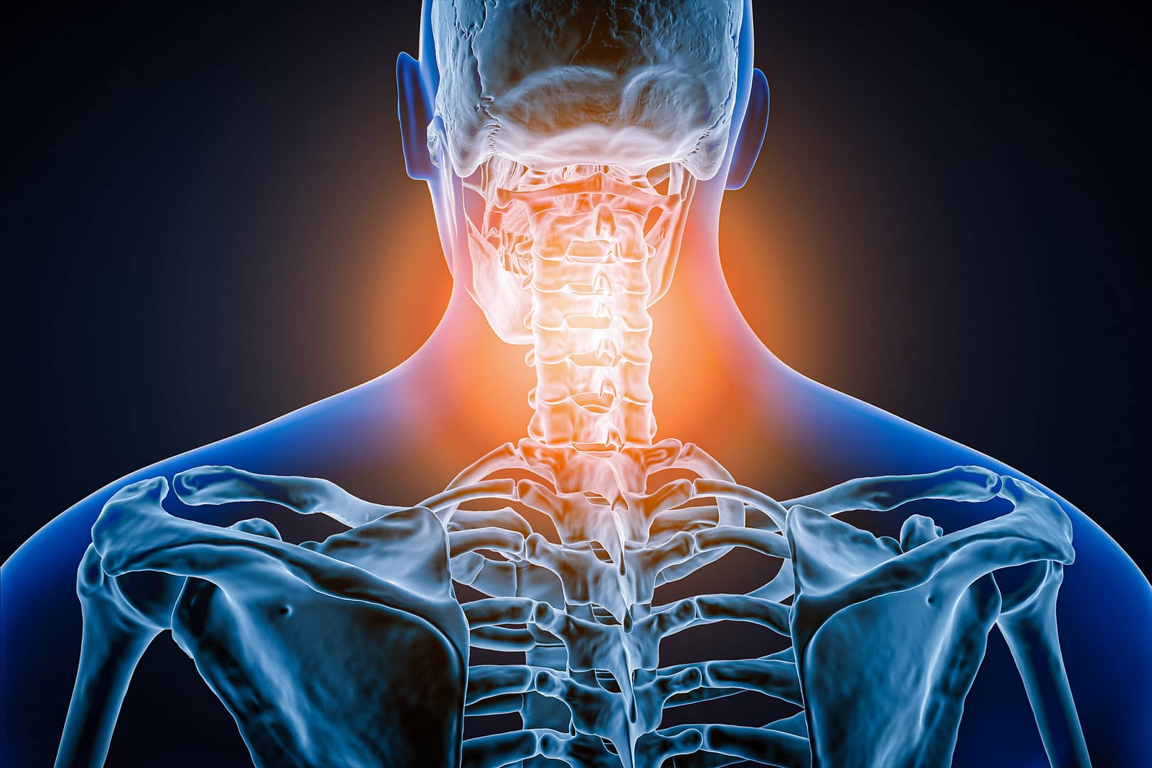 Image of cervical spine, highlights area where Spinal Cord Catheterization procedure begins treating the patient