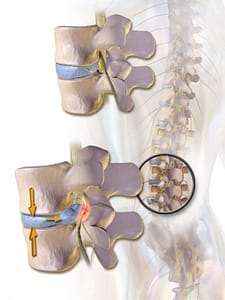 Degenerative Disc Disease