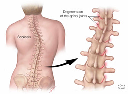 degenerative scoliosis