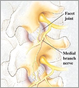 Medial Branch Block. Image of facet joint and medial branch nerve