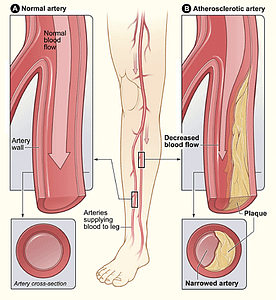 Peripheral Artery Disease illustration