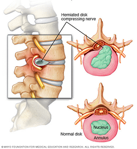 Herniated Disc