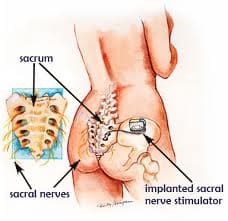 sacral nerve stimulation