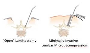 Lumbar Microdecompression. image showing lumbar microdecompression procedure