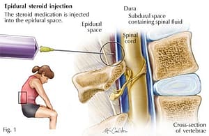 Transforaminal Epidural Steroid Injection