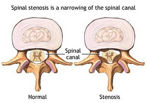 Spinal Stenosis illustration