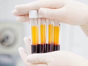 regenerative medicine; platelet rich plasma therapy. images of tubes of PRP
