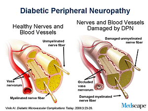 diabetic neuropathy