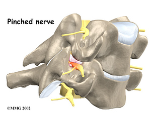 Cervical Radiculopathy