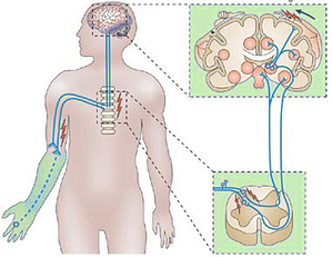 phantom limb pain