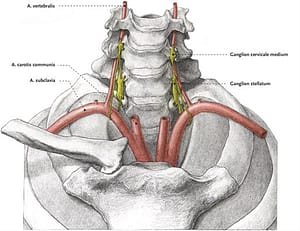 stellate ganglion block. image of cervical spine showing ganglion stellatum