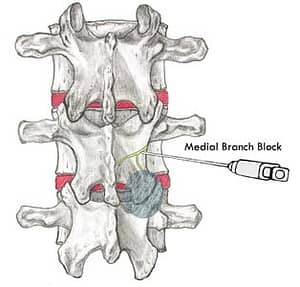 Medial Branch Block. illustration of medical branch block injection