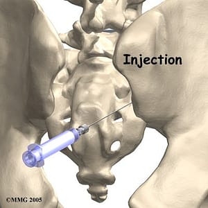 image of sacroiliac joint injection