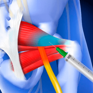 Piriformis injection - can help with treating sciatica pain