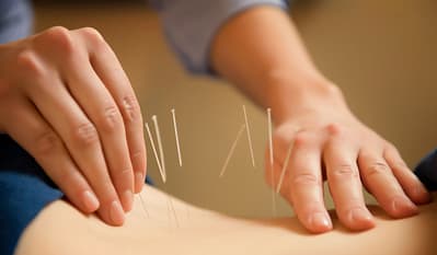 Acupuncture