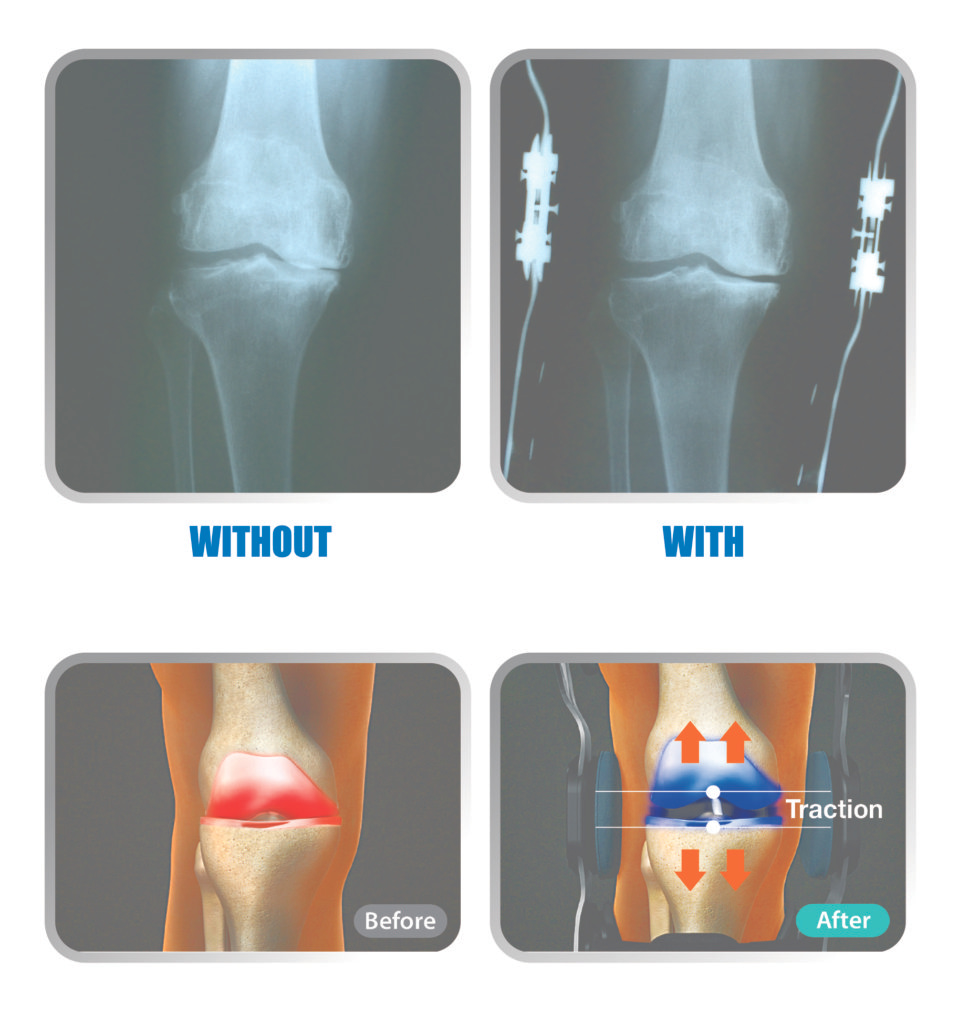 knee brace before and after